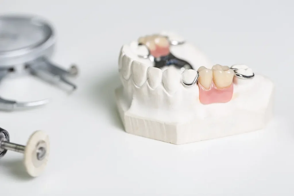 Dental bridge